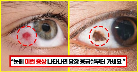 “눈에 검은색 점은 가장 흔한 악성종양입니다” 전문의가 알려주는 눈이 보내는 건강 상태 5가지