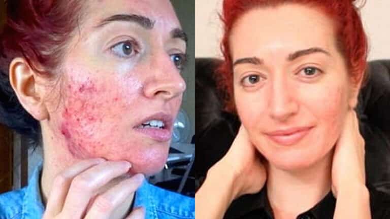 15년간 지독한 여드름 피부로 살던 여성이 ‘이것’ 끊자 얼굴에 생긴 놀라운 변화
