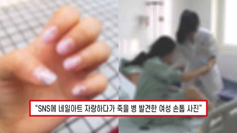 “빨리 병원 가보세요..” SNS에 손톱 사진 올린 여성이 누리꾼들 권유로 병원가자 듣게 된 충격적인 진단 내용